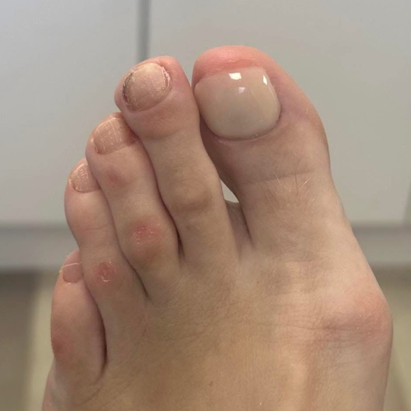 Pedique Nail Reconstruction