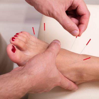 Acupuncture/Dry needling