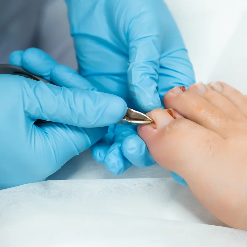 podologist-procedure-ingrown-nail-removal-with-nippers